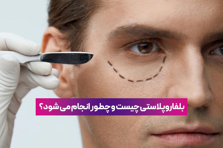 بلفاروپلاستی