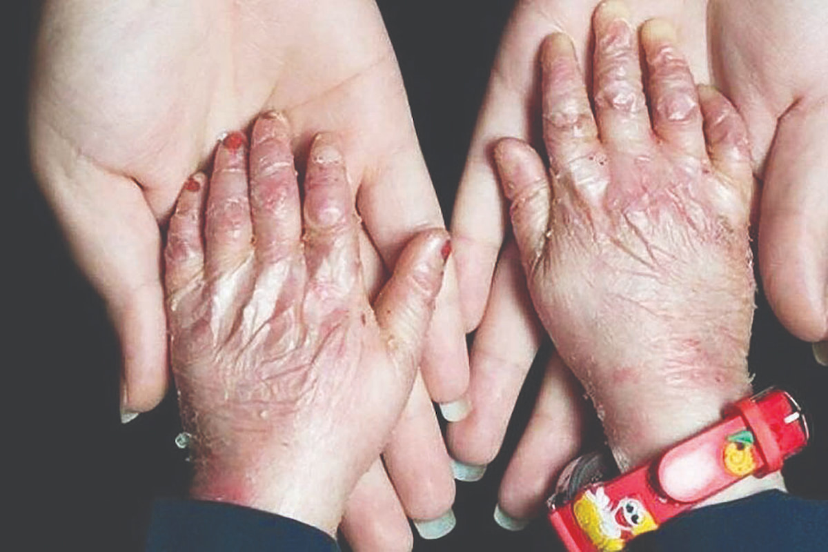 از هر ۵۰‌هزار تولد یک نفر به بیماری پروانه‌ای مبتلاست