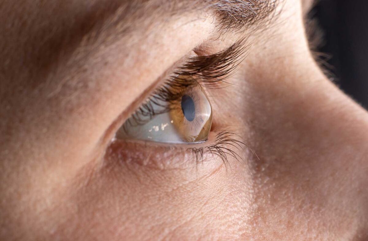 چرا ایرانی‌ها ۱۰ برابر بیشتر از جهان به قوز قرنیه مبتلا می‌شوند؟