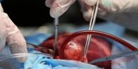 امیدی تازه برای بیماران پیوند کلیه؛ کشف نشانگر پیش‌بینی‌کننده عمر پیوند
