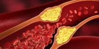 داروی جدید برای کاهش کلسترول خون و ریسک سکته قلبی