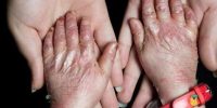 ۲۵ بیماری جدید به فهرست بیماری‌های نادر کشور اضافه شد